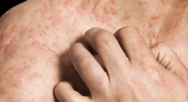 pinpoint red dots on skin defenciey