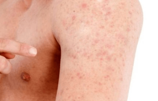 colchicine pinpoint red spots on skin