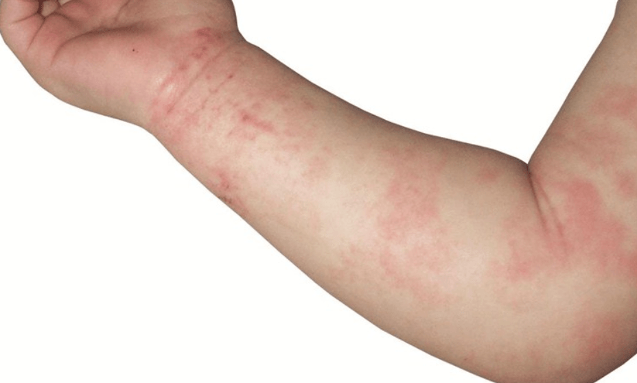 How To Get Rid Of Psoriasis Fast