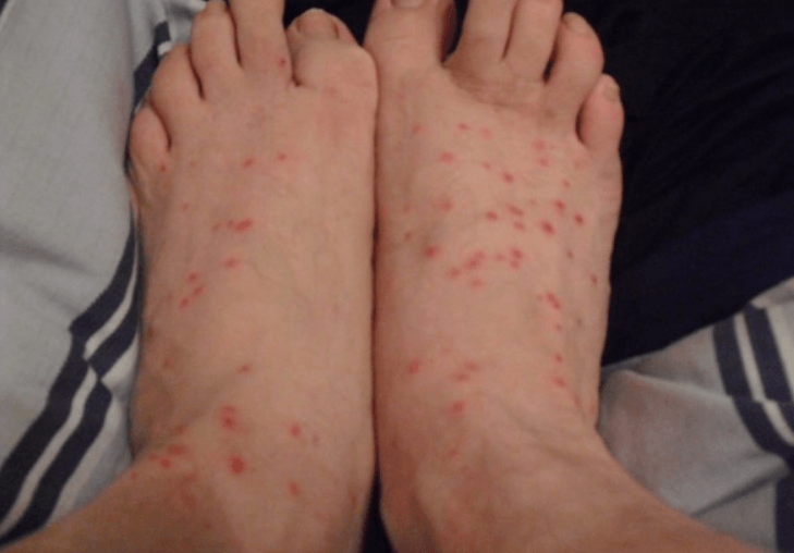 Symptoms of Chigger Bites