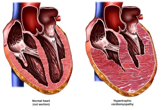 Hypertrophic Cardiomyopathy