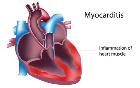 Myocarditis