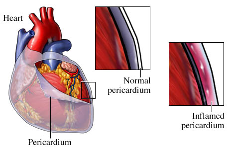 Pericarditis