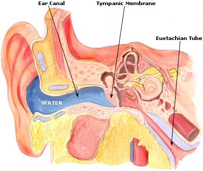 Swimmer’s Ear