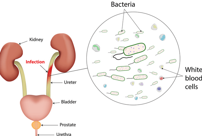 Urinary Tract Infection