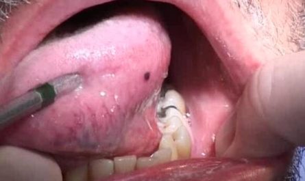 Blood Blister in Mouth