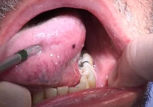 Blood Blister in Mouth