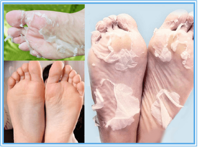 Top 10 Natural Remedies to Remove Calluses From Feet