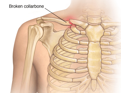 Collarbone trauma