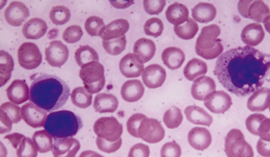 14 Causes of Low Lymphocyte Count(Lymphocytopenia)