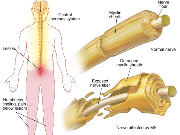 Multiple Sclerosis