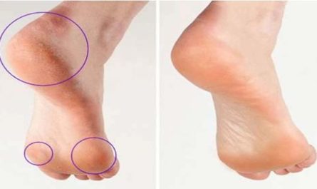 Remove Calluses on Feet