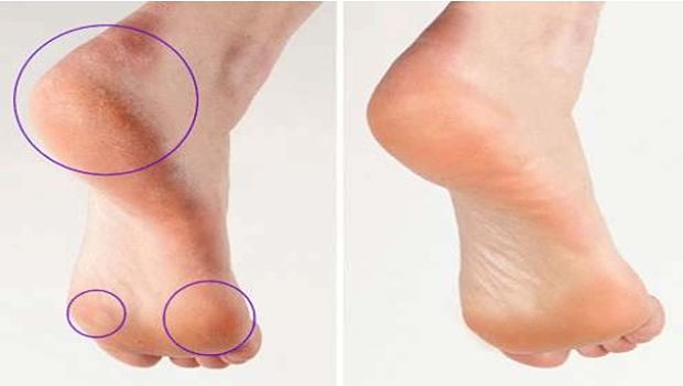 Remove Calluses on Feet