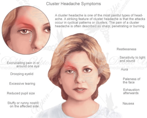 Eye Pain from a Cluster Headache