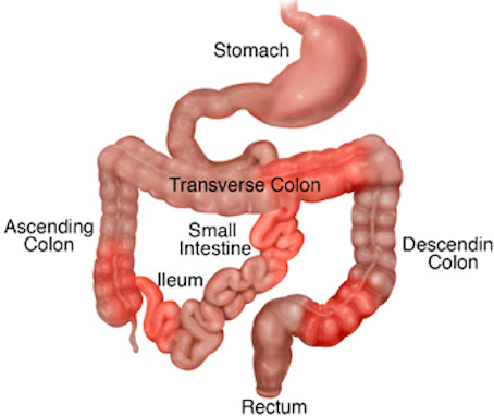Crohn’s Disease