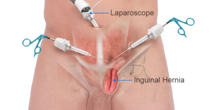 Inguinal (Groin) Hernia