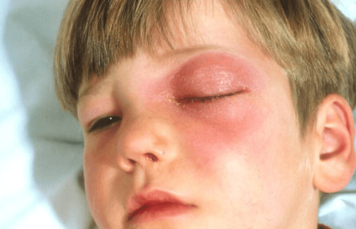 Eye pain from Orbital Cellulitis