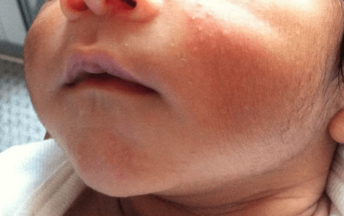 Bumps on Your Face