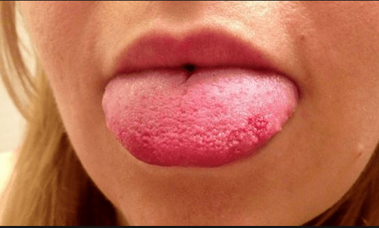 Bumps on Back of Tongue