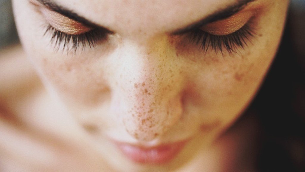 Dark Spots on Face: 11 Common Causes with Treatment