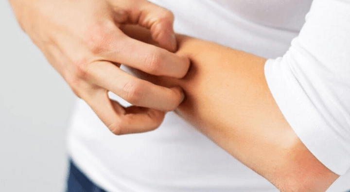 20 Natural Remedies to Get Rid of Ringworm Fast