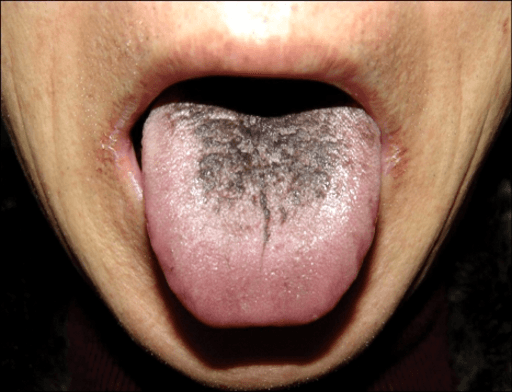 Black Hairy or Coated Tongue