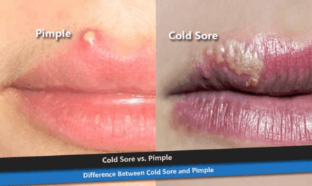 Cold Sore or Pimple on Lip