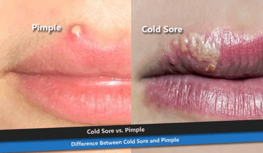 Cold Sore or Pimple on Lip