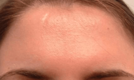 Get Rid of Cyst on Forehead