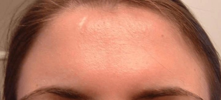 Get Rid of Cyst on Forehead