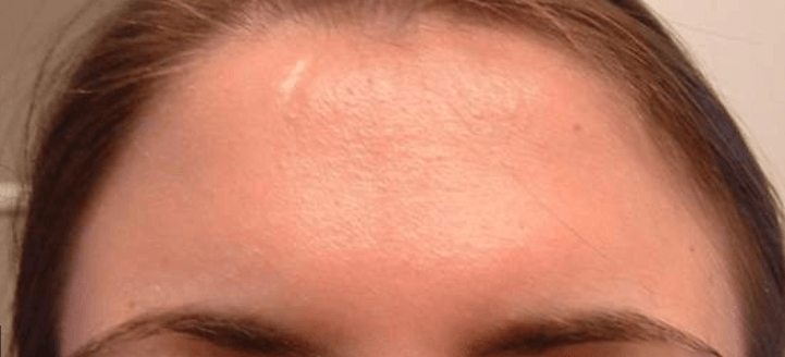 cyst-on-forehead-causes-and-natural-remedies