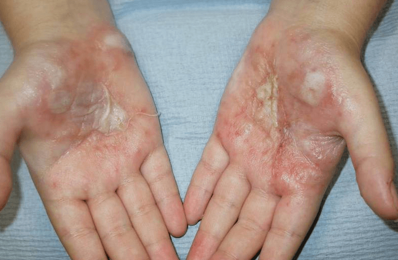 Herpetic Whitlow(Herpes on Hands) Causes and Treatment