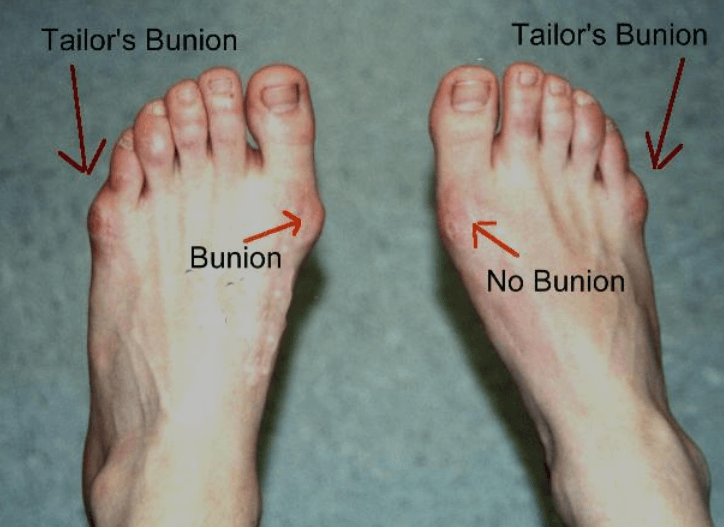 Tailors Bunion