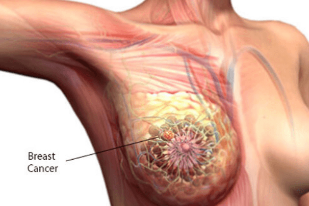 painful lump in breast