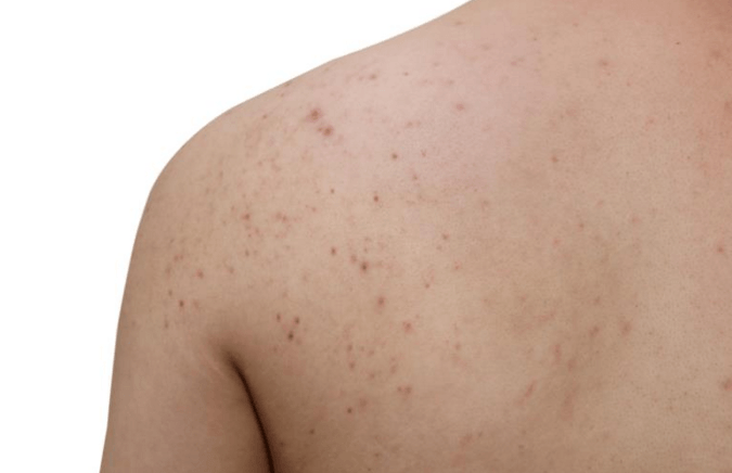 How to Get Rid of Shoulder Acne in a Week