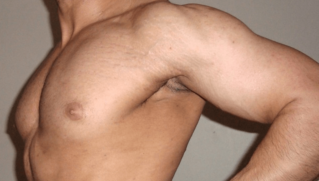 How to Get Rid of Stretch Marks on Men’s Skin