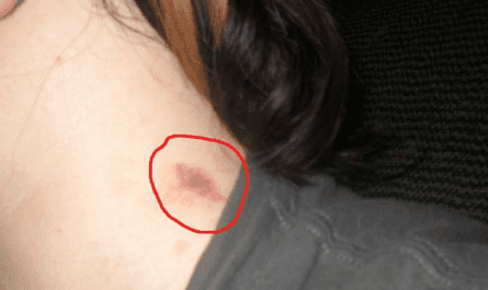 How to Hide a Hickey Without Makeup