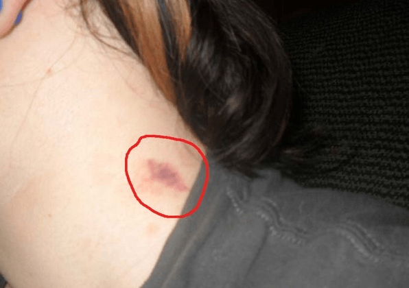 How to Hide a Hickey Without Makeup