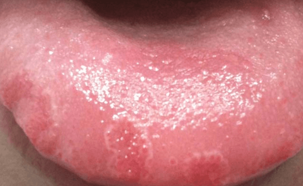 a Sore or Bumpy Tongue