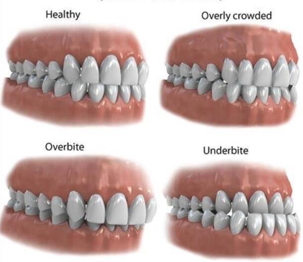 Why Is It So Important To Correct An Overbite?