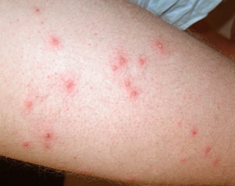 12 Common Causes of Itchy Red Bumps on Skin (2022)