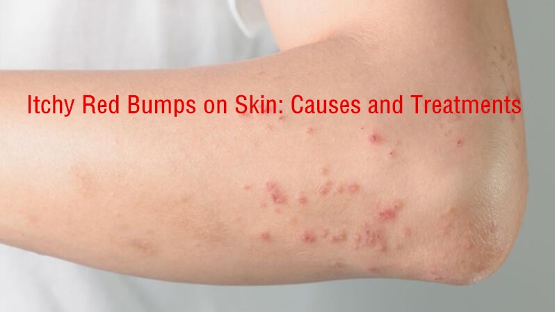 Itchy Red Bumps on Skin:12 Common Causes with Treatment