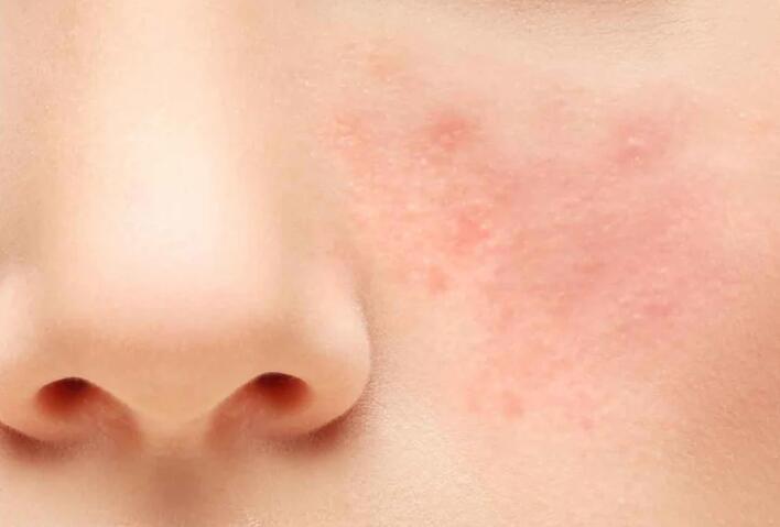 Rosacea