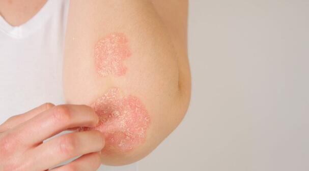 Atopic dermatitis