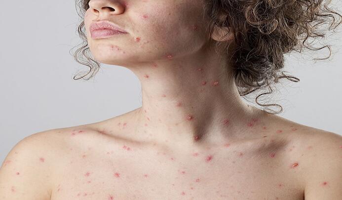 Chickenpox