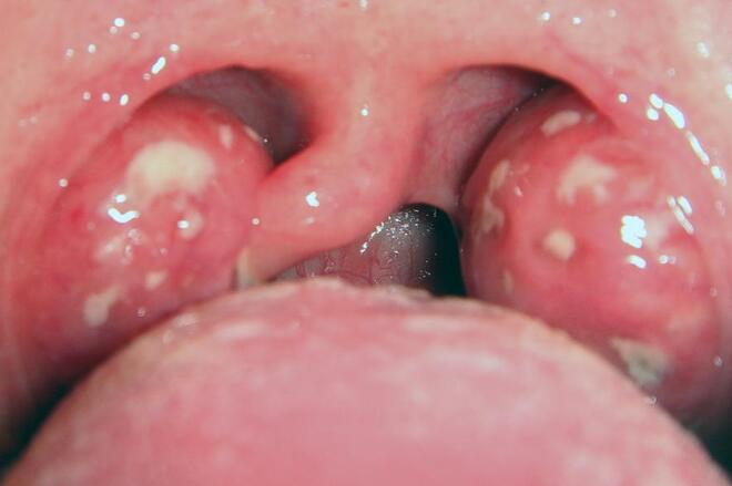 Tonsillitis