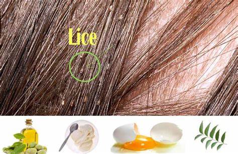 How to Get Rid of Head Lice:10 Natural Remedies