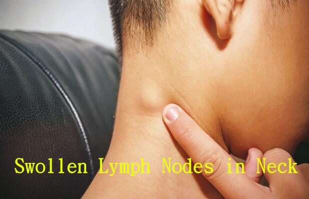Swollen Lymph Nodes in Neck
