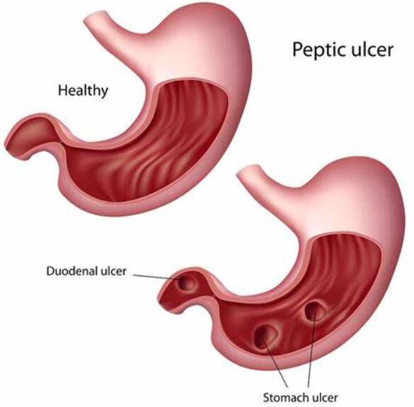Peptic ulcer