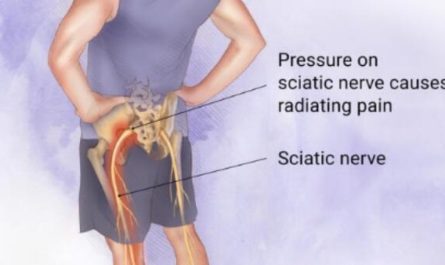 What is Sciatic Nerve Pain